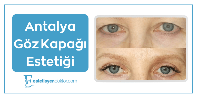 Antalya Göz Kapağı Estetiği
